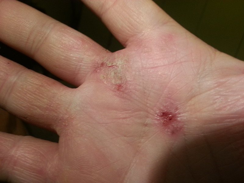 Evommune Starts Making Case to Challenge Dominance of Sanofi’s Dupixent in Atopic Dermatitis