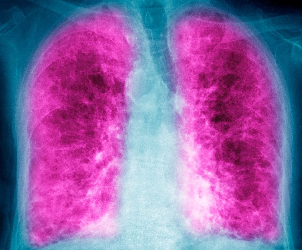 Avalyn Pharma Takes a Breath to Raise 0M in IPO Cash for Lung Drug Trials