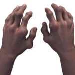 Crystalys Therapeutics Tacks On 0M for Pivotal Tests of Gout Drug