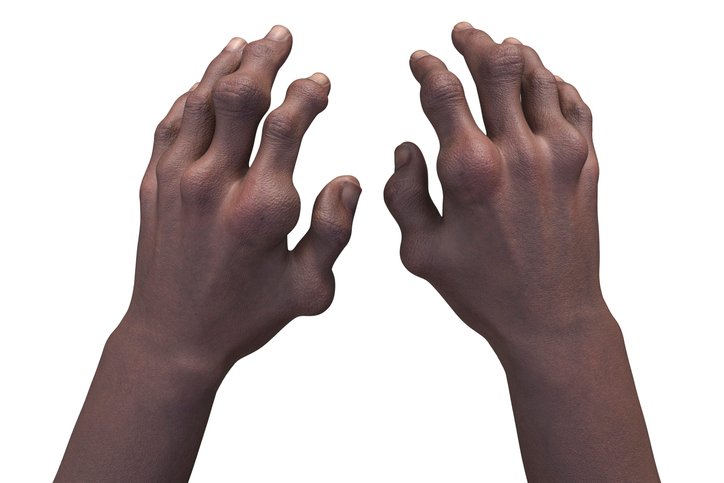 Crystalys Therapeutics Tacks On 0M for Pivotal Tests of Gout Drug